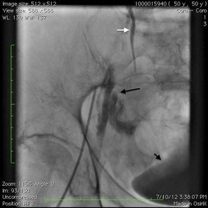 Angiogram showing perforation (long arrow) from the dissection plane in the external iliac artery causing retroperitoneal bleeding as evidenced by displacement of the urinary bladder (short arrow). Also shown is the ureter (white arrow).