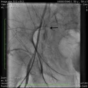 Angiogram of the ipsilateral common femoral sheath showing sealed perforation (arrow) and closed dissection plane after prolonged balloon inflation in the distal popliteal artery.