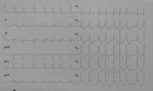 The ECG shows an unusual 4-mm convex ST segment elevation in C4–C6 with biphasic T waves.