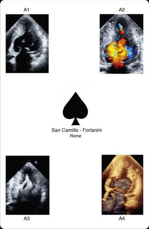 Apical hypertrophic cardiomyopathy shows the ace up its sleeve. A1: two-dimensional transthoracic echocardiography; A2: color Doppler transthoracic echocardiography; A3: contrast-enhanced transthoracic echocardiography; A4: real-time three-dimensional reconstruction.