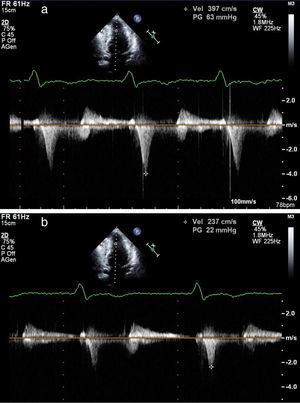 Transthoracic echocardiography, apical 4-chamber view showing (a) a mid-ventricular gradient of about 63 mmHg and (b) a significant decrease in the gradient after administration of an intravenous bolus of atenolol.