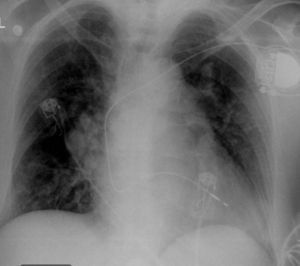 Chest X-ray.