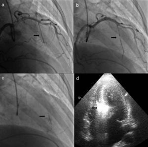 Procedimento. a) Angiografia com incidência oblíqua-direita-cranial da coronária esquerda, mostrando septal alvo. b) Cateterização seletiva da septal alvo com colocação de cateter de balão. c) Angiografia seletiva da septal alvo, com injeção de contraste através do lúmen do cateter de balão. d) Ecocardiografia transtorácica em quatro câmaras. Septo basal hipercogénico após injeção de contrate intramiocárdico, através do lúmen do cateter de balão.