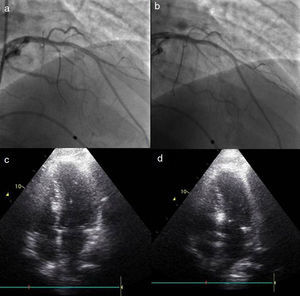 Alteração da septal alvo após injeção de contraste intracoronário. a) Cateterização seletiva da segunda septal. b) Cateterização selectiva da primeira septal. c) Opacificação da parte direita do septo após injeção de contrate na segunda septal. d) Opacificação da região adequada do septo, porção basal em relação com o folheto anterior da válvula mitral, com injeção de contraste na primeira septal.