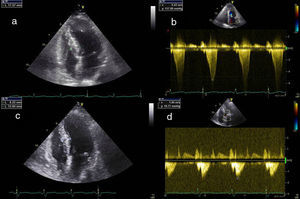 Resultados ecocardiográficos após três meses. a) Ecocardiografia transtorácica quatro câmaras prévia à intervenção. b) Doppler contínuo mostrando gradiente subaórtico prévio à intervenção. c) Ecocardiografia transtorácica quatro câmaras, três meses após a intervenção, mostrando diminuição da espessura da porção basal do septo. d) Doppler contínuo três meses após intervenção mostrando diminuição do gradiente subaórtico.
