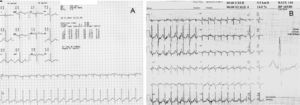 Prova de esforço; painel A: prova de esforço realizada após a síndrome coronária aguda evidenciando isquemia miocárdica no pico do esforço; painel B: prova de esforço realizada após a cirurgia de revascularização, sem evidência de isquemia.