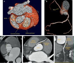 Tomografia computorizada multidetetores; painéis A e B: 3D volume-rendered demonstrando a origem da coronária direita na parede ântero-lateral esquerda da aorta, acima os seios de Valsalva e com trajeto inicial entre a aorta e a porção ascendente da artéria pulmonar; painéis C, D e E: imagens de reconstrução multiplanar demonstrando o trajeto extramural e interarterial da coronária direita. RCA: coronária direita; Pulmonary ASC: artéria pulmonar; LM: tronco comum.