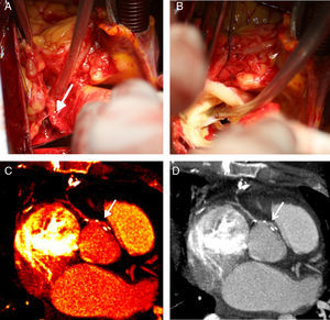 Painel A: dissecção cirúrgica do início da coronária direita revelando a sua origem na parede ântero-lateral esquerda da aorta e trajeto extramural e interarterial. Painel B: após transeção da aorta, constata-se origem coronária acima dos seios de Valsalva, posteriormente à comissura entre as cúspides direita e esquerda; notar a obliquidade do ostium coronário. Painéis C e D: tomografia computorizada multidetetores realizada após cirurgia de revascularização do miocárdio. As imagens de reconstrução multiplanar demonstram a anastomose látero-lateral (setas). As imagens de densidade elevada correspondem aos clips cirúrgicos empregues.