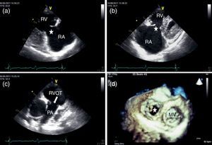 Transthoracic echocardiography: thickened, retracted and immobile tricuspid (a and b) and pulmonary valves (c); 3D en face view of the tricuspid valve open during systole (d). MV: mitral valve; PA: pulmonary artery; RA: right atrium; RV: right ventricle; RVOT: right ventricular outflow tract.
