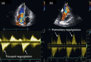 Transthoracic echocardiography: severe tricuspid (a) and pulmonary (b) regurgitation, shown by color Doppler (top) and continuous wave Doppler (bottom).