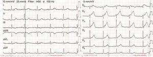 Electrocardiogram revealing 1–2 mm ST elevation in the anterior leads.
