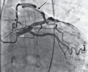 Contrast injection in the left coronary artery showing a large connection between the left main and the diagonal branch of the left anterior descending (black arrow) and a fistula between the intercoronary connection and the left atrium (white arrow). D: diagonal; LM: left main.