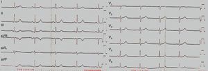 Electrocardiogram demonstrating normal sinus rhythm.
