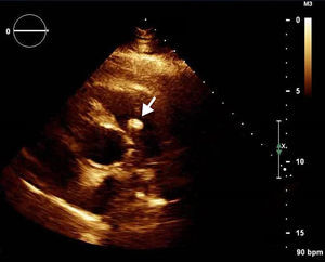 Parasternal short-axis view, transthoracic echocardiography, demonstrating the mass (arrow) attached to the right leaflet of the pulmonary valve.