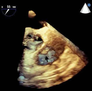 Three-dimensional transesophageal echocardiogram (mid-esophageal view) showing the tumor (arrow) on the pulmonary valve.