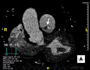 Coronal computed tomography angiography demonstrating a partially calcified mass (arrow) at the level of the pulmonary valve.