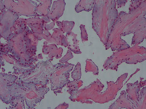 Histology of the resected mass showing papillary fronds with a central core of dense collagen surrounded by endothelial cells.