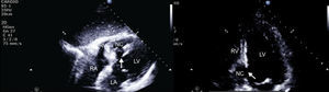 Transthoracic echocardiography, subcostal (left) and apical 4-chamber view, zoom on the left ventricle (right). Rupture of the interventricular septum, with septal dissection. LA: left atrium; LV: left ventricle; NC: neocavity formed by the dissection of the interventricular septum; RA: right atrium; RV: right ventricle. Arrow: interventricular septal rupture.