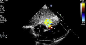 Transthoracic echocardiography, subcostal view. After surgery, an interventricular communication remains, with left-to-right shunt. LA: left atrium; LV: left ventricle; NC: neocavity formed by the dissection of the interventricular septum; RA: right atrium. Arrow: interventricular septal rupture.