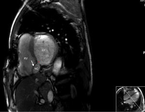 Cardiac magnetic resonance image from cine balanced steady-state free procession sequences (bright blood), short-axis view at the level of the basal ventricular segments. There is a residual defect in the posterior interventricular septum, communicating with a neocavity formed by the aneurysmal dissection of the septum. LV: left ventricle; NC: neocavity formed by the dissection of the interventricular septum; RV: right ventricle. Arrow: interventricular septal rupture; asterisk: residual ventricular septal defect.