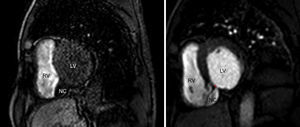 Cardiac magnetic resonance gadolinium perfusion imaging. Immediately after contrast injection, flow can be seen from the left ventricle into the cavity formed by the interventricular septal dissection, which finally drains into the apical region of the right ventricle. LV: left ventricle; NC: neocavity formed by the dissection of the interventricular septum; RV: right ventricle. Asterisk: residual ventricular septal defect.
