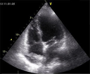 Ecocardiograma transtorácico apical quatro câmaras, realizado na avaliação inicial evidenciando imagem ecodensa heterogenia (3x2,2cm) aderente ao teto da aurícula direita, interpretada como trombo.