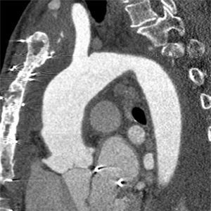 Tomografia computorizada torácica, corte sagital interessando a aorta ascendente, documentando dilatação da aorta ascendente, sem evidência de recidiva, seis semanas após a cirurgia.