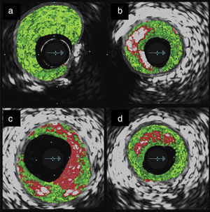 Types of atherosclerotic plaque characterized by intravascular ultrasound virtual histology: (a) fibrotic plaque; (b) fibrocalcific plaque; (c) thin‐cap fibroatheroma; (d) thick‐cap fibroatheroma.