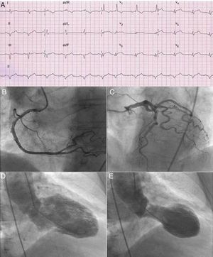 ECG showing ST‐segment elevation in the anterior precordial leads (A); right coronary angiography (B) and left coronary angiography (C) without significant obstructive disease; left ventriculogram at end‐diastole (D) and end‐systole (E) showing basal hyperkinesia with apical ballooning.