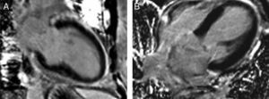 Left ventricular vertical (A) and horizontal (B) long‐axis images revealing no myocardial delayed enhancement.