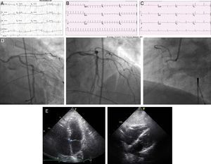 Right atrial infarction: initial ECG with chest pain (A), with palpitations (B) and after intravenous diltiazem (C). Coronary angiogram (D) and transthoracic echocardiogram (E).