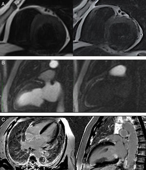 (A) Short‐axis T2‐weighted images with multiple unexpected small vascular structures in the anterior and posterior interventricular grooves; (B) first‐pass myocardial rest perfusion imaging in 2‐chamber view, showing epicardial hyperenhancement of the anterior wall simultaneous with aortic opacification (left) and earlier perfusion of the mid and apical anterior segments (right); (C) subendocardial late gadolinium enhancement in the apical inferior myocardial segment, in 4‐chamber and 2‐chamber views.