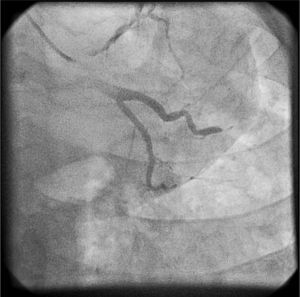 Coronariografia evidenciando trombo ocluindo o segmento distal da artéria 1.a obtusa marginal.