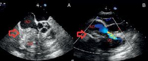 Imagens de ecocardiograma transesofágico realizado ao doente para estudo de massa (seta) intracardíaca. A: massa heterogénea, com zonas hipo e hiperecogénicas, pouco móvel aderente, à face lateral da aurícula direita com extensão à válvula tricúspide, ventrículo direito e pericárdio. B: obstrução causada pela massa ao fluxo nas cavidades direitas (AD: aurícula direita; VD: ventrículo direito).