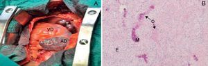 Aspecto macroscópico (A) e microscópico (B) do tumor. A: massa tumoral (T), rígida, ocupando quase toda a aurícula direita (AD); B: histologia da peça operatória onde se observa proliferação mesenquimatosa, epitelioide (E) e osteoide (O), com focos de mineralização (M) sugerindo tratar‐se de osteosarcoma; coloração com hematoxilina‐eosina. VD: ventrículo direito.