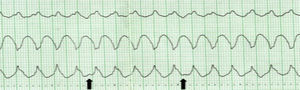 Taquicardia de QRS largos, em que existe evidência de dissociação AV (ondas P representadas pelas setas), que é indicativa da origem ventricular.