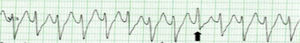 Taquicardia de complexos largos, em que a presença de complexo de fusão (seta) permitiu o diagnóstico de taquicardia ventricular.