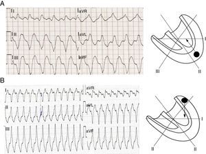 Localização da origem da TV segundo o eixo do QRS. A ‐ uma TV com origem apical tem um eixo de despolarização ventricular dirigido superiormente, pelo que os complexos QRS serão negativos em DII, DIII e aVF. B ‐ uma TV com origem basal resulta em QRS positivos em DII, DIII e aVF (Fonte: Wellens2).