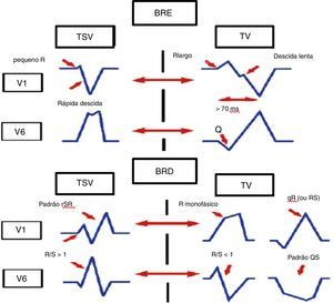 Critérios morfológicos nas derivações V1 e V6 para diferenciação de taquicardia de QRS largos.