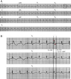 Aplicação do critério vi/vt. A figura A mostra um traçado de taquicardia de QRS largos de 12 derivações. A vi é medida numa derivação onde está presente um QRS bi ou multifásico e a velocidade de ativação é a mais rápida. Nessa derivação é escolhido um complexo QRS onde o início e final do QRS sejam perfeitamente visíveis. B – Linhas verticais marcam o início e o final do QRS escolhido e pequenas estrelas marcam os 40ms iniciais e terminais do QRS. Durante os 40ms iniciais do QRS, o impulso deslocou‐se verticalmente 0,8mV, e assim vi=0,8. Durante os 40ms finais o impulso deslocou‐se verticalmente 0,2mV e assim vt=0,2mV. Assim, a relação vi/vt sugere o diagnóstico de TSV (Fonte: Vereckei et al.18).