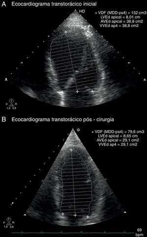 Imagens do ecocardiograma transtorácico, plano apical de quatro câmaras em telediástole, que mostram a redução do volume telediastólico do ventrículo esquerdo: A) antes da terapêutica; B) dois meses pós‐cirurgia.