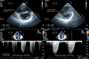 Echocardiographic measurements in a pulmonary hypertension patient at rest (left) and at peak exercise (right); top – diastolic left ventricular eccentricity index; bottom – RV/RA gradient. D1 and D2: left ventricular diameters; LV exc index: diastolic left ventricular eccentricity index; RV/RA grad: right ventricular/right atrial gradient in systole.