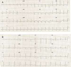 (A) ECG on admission showing ST-segment elevation in precordial leads; (B) ECG on the third day of hospitalization demonstrating T-wave inversion in precordial leads.