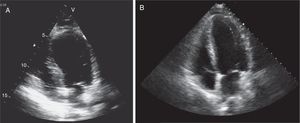 Transthoracic echocardiogram in 4-chamber apical view (systolic frames) on admission revealing akinesia of the mid-apical segments and aneurysmatic dilatation (A) and echocardiographic reassessment (B), on the sixth day of hospitalization, showing recovery of left ventricular systolic function, with no segmental wall motion abnormalities.