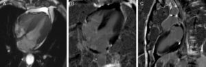 Cardiac magnetic resonance imaging. Cine true fast imaging with steady-state free precession in 4-chamber at end-systole (A) shows normal contractility of the left ventricular apex with complete resolution of apical ballooning; 4-chamber (B) and 2-chamber (C) delayed post-contrast imaging shows no abnormal myocardial enhancement.