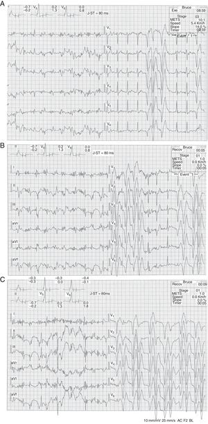 Traçado eletrocardiográfico obtido durante a prova de esforço aos 8:59min, pico de esforço (imagem A), aos cinco segundos da recuperação (imagem B) e aos nove segundos da recuperação (imagem C).