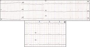 A. ECG standard de 12 derivações; em (B) visualiza‐se em pormenor V1 a V3; as setas apontam para as ondas épsilon.