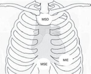 Disposição dos elétrodos no ECG de Fontaine. MIE: membro inferior esquerdo; MSD: membro superior direito; MSE: membro superior esquerdo. Fonte: Chiladakis et al.8.