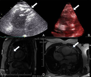 Alterações documentadas nos exames de imagem. (A) Ecocardiograma transtorácico de duas dimensões. (B) Ecocardiograma transtorácico de três dimensões. (C) e (D) ressonância magnética cardíaca. As setas mostram as dilatações saculiformes na parede livre do ventrículo direito.