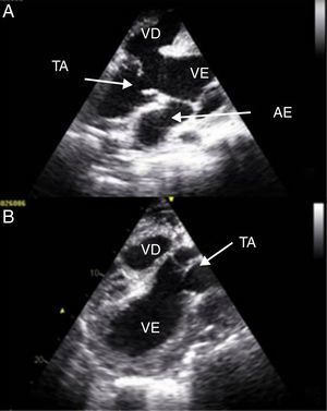 Grande vaso comum à saída de ambos os ventrículos (VE e VD) – tronco arterioso (TA) – (A‐ janela subcostal; B‐ janela paraesternal eixo longo).